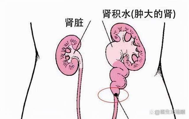 中山肾结石，中山肾结石手术，中山肾结石碎石大概多少钱