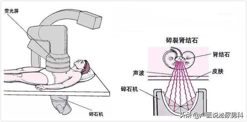 中山尿结石，中山尿结石多少钱，中山尿结石手术费一般多少钱