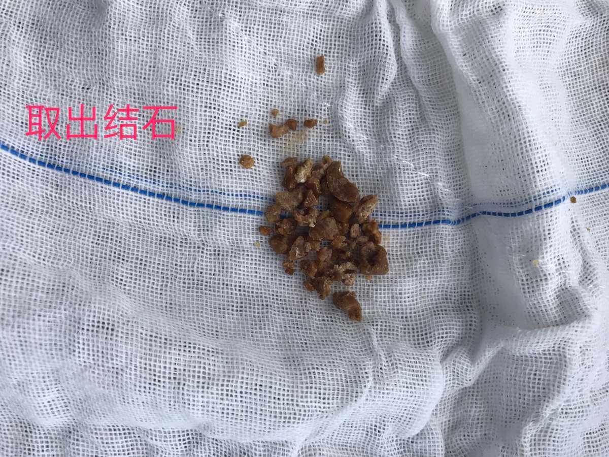 中山尿结石，中山尿结石多少钱，中山尿结石经皮肾镜多少钱