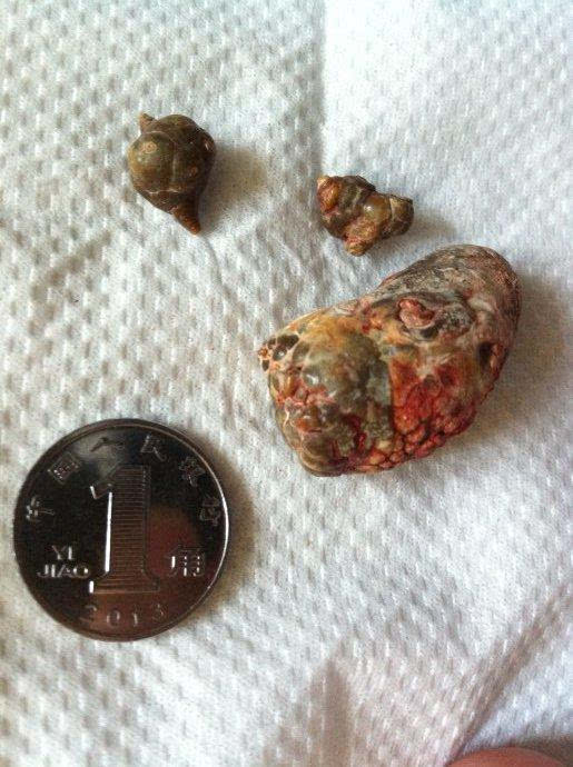 中山碎石多少钱，中山结石多少钱，中山结石碎石大概要多少钱